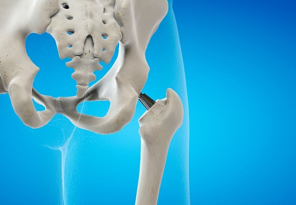 Kalça Labrum Yırtığı : Kasık Ağrılarının Altındaki Gizli Tehlike!