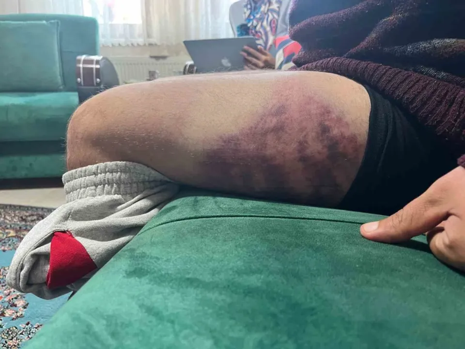 Otizmli şahıs odunluğa baktı diye odunla darbedildi